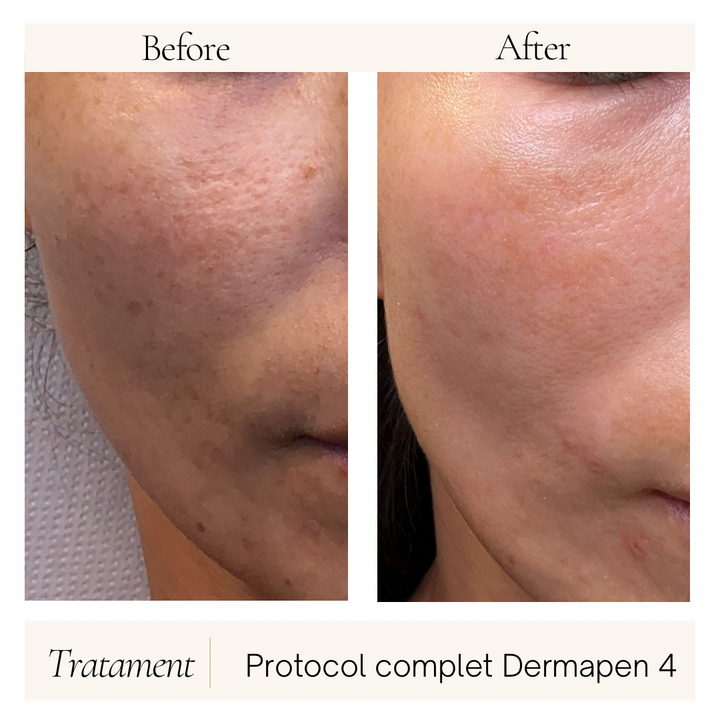 Protocol Dermapen VIP EXO