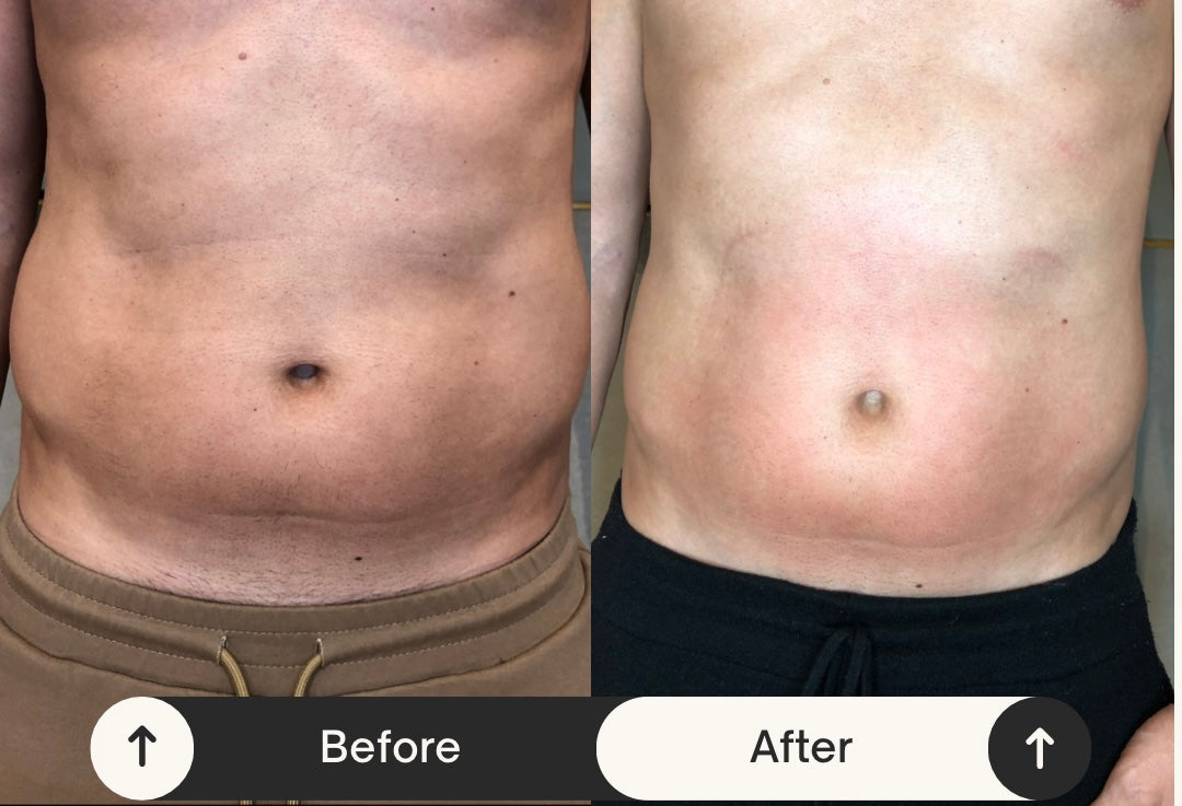 Remodelare și Fermitate Acceleratǎ cu NuEra® Tight & Lipolizǎ sau Fillere de biorevitalizare Sculptra