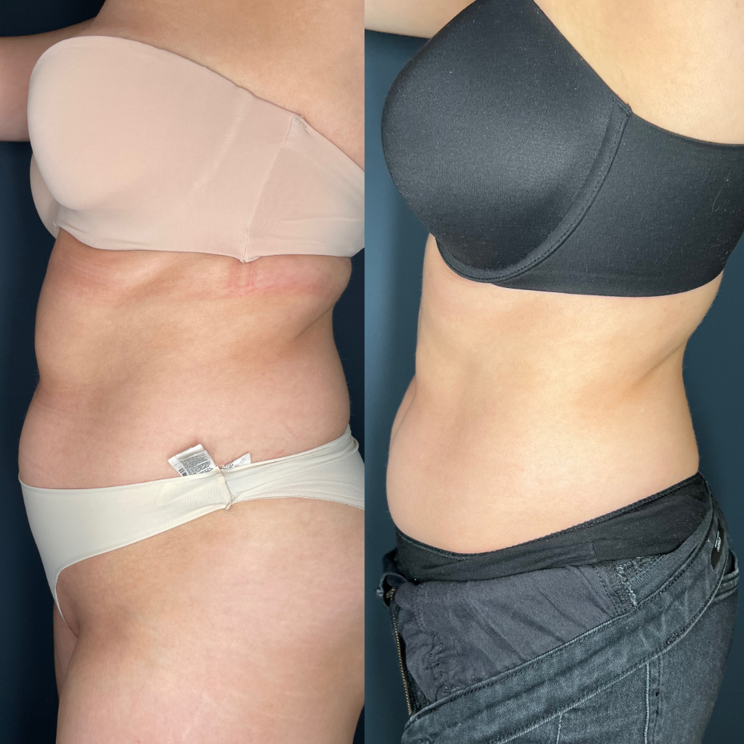 Remodelare și Fermitate Acceleratǎ cu NuEra® Tight & Lipolizǎ sau Fillere de biorevitalizare Sculptra