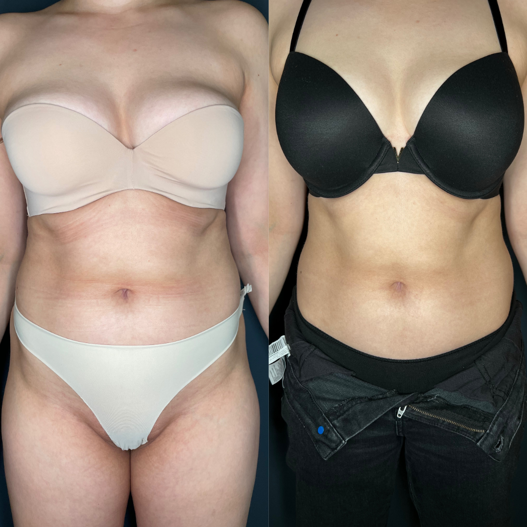 Remodelare și Fermitate Acceleratǎ cu NuEra® Tight & Lipolizǎ sau Fillere de biorevitalizare Sculptra