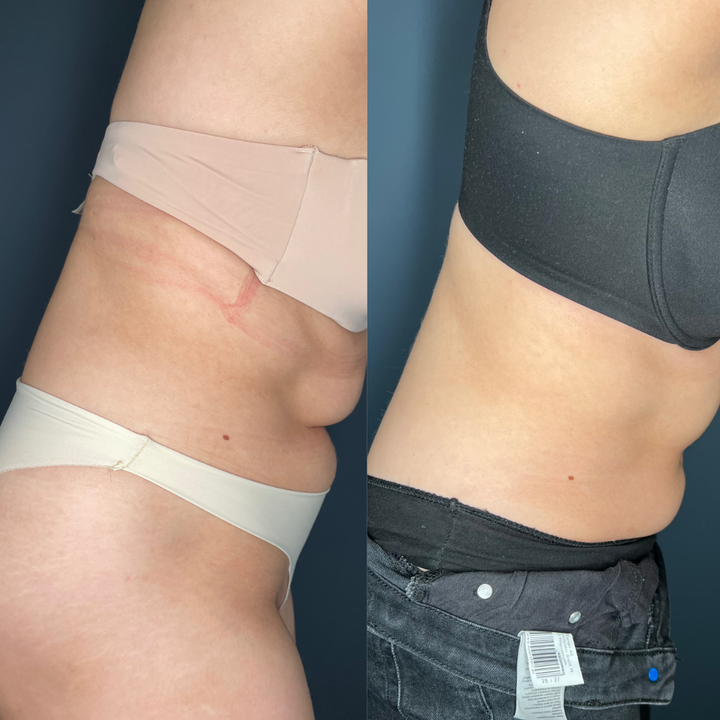 Remodelare și Fermitate Acceleratǎ cu NuEra® Tight & Lipolizǎ sau Fillere de biorevitalizare Sculptra