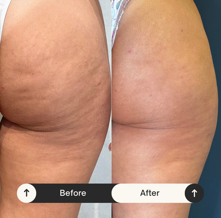 Remodelare și Fermitate Acceleratǎ cu NuEra® Tight & Lipolizǎ sau Fillere de biorevitalizare Sculptra