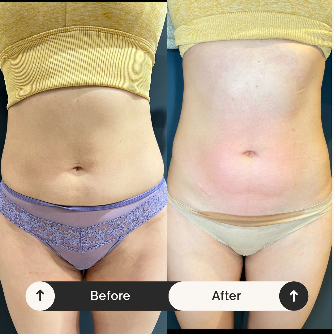 Remodelare și Fermitate Acceleratǎ cu NuEra® Tight & Lipolizǎ sau Fillere de biorevitalizare Sculptra