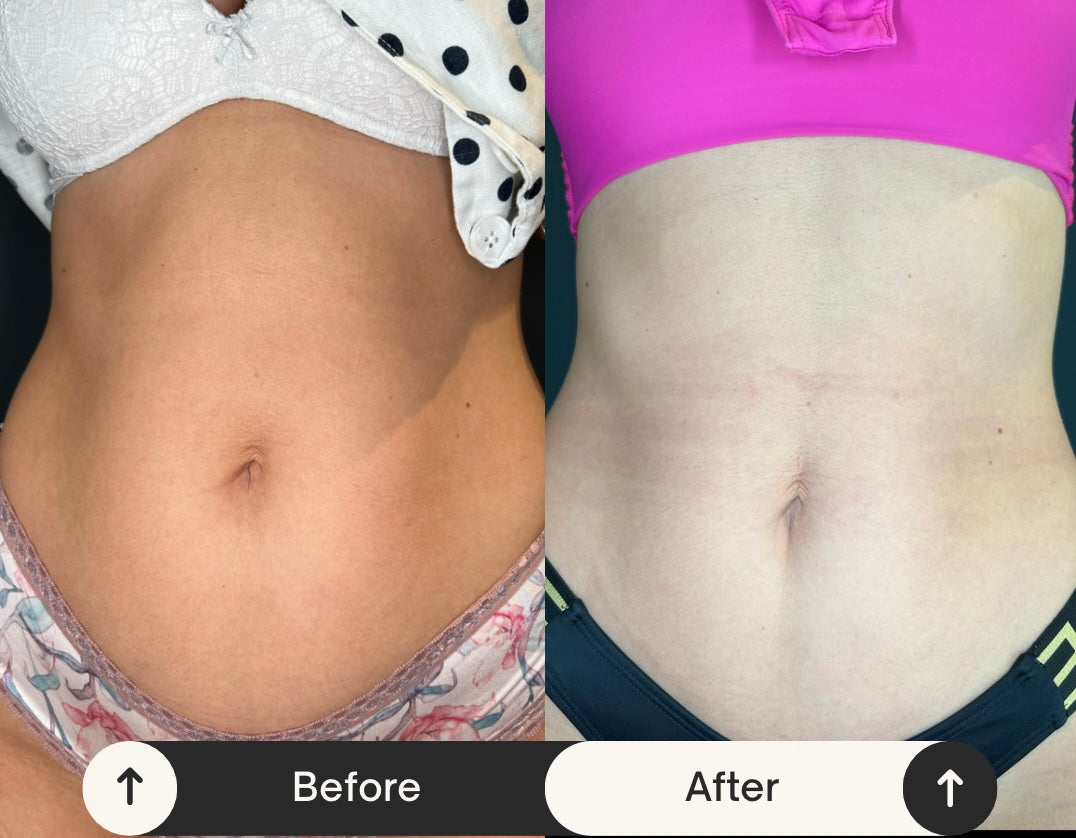 Remodelare și Fermitate Acceleratǎ cu NuEra® Tight & Lipolizǎ sau Fillere de biorevitalizare Sculptra