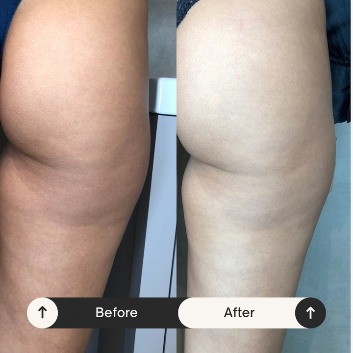 Remodelare și Fermitate Acceleratǎ cu NuEra® Tight & Lipolizǎ sau Fillere de biorevitalizare Sculptra