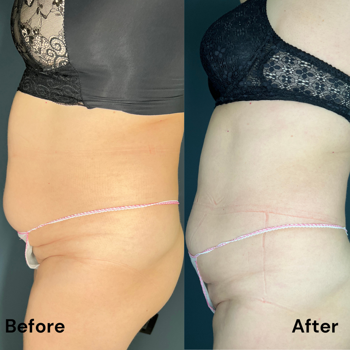 Remodelare și Fermitate Acceleratǎ cu NuEra® Tight & Lipolizǎ sau Fillere de biorevitalizare Sculptra