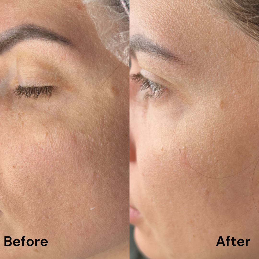 Protocol Dermapen VIP EXO