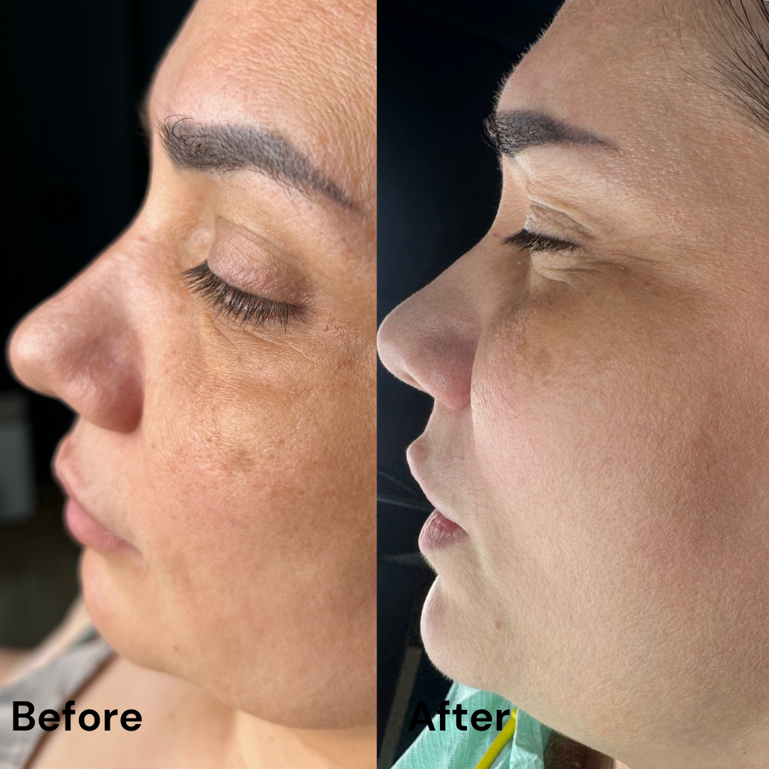 Tratarea imperfecțiunilor cu Dermapen 4 & MG Collection : pete hiperpigmentare/cuperoză/ riduri