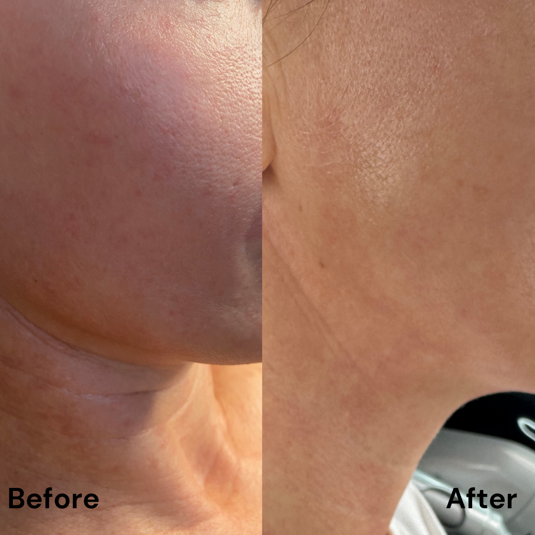Tratarea imperfecțiunilor cu Dermapen 4 & MG Collection : pete hiperpigmentare/cuperoză/ riduri