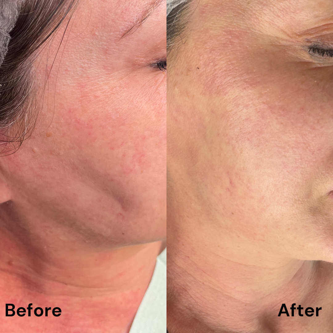 Protocol Dermapen VIP EXO