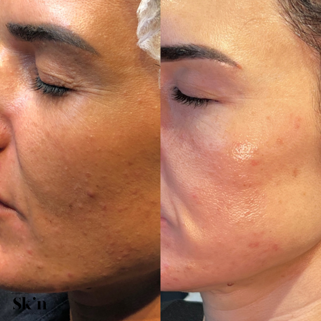 Microneedling Dermapen 4 tratament Acnee/ cicatrici post-acneice