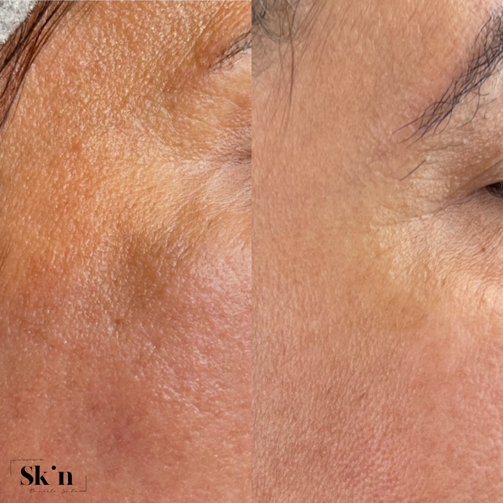 Protocol Dermapen VIP EXO