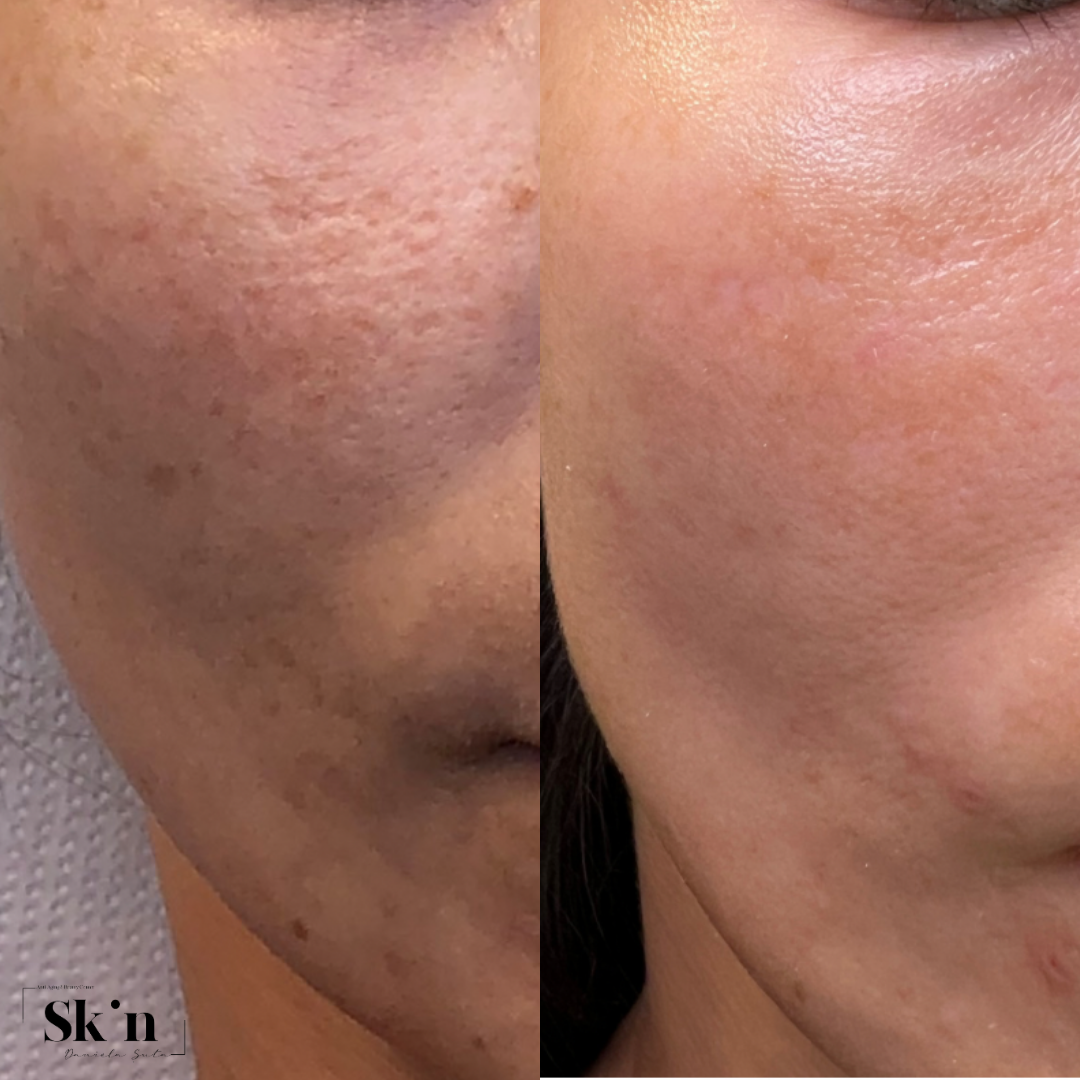 Protocol Dermapen VIP EXO
