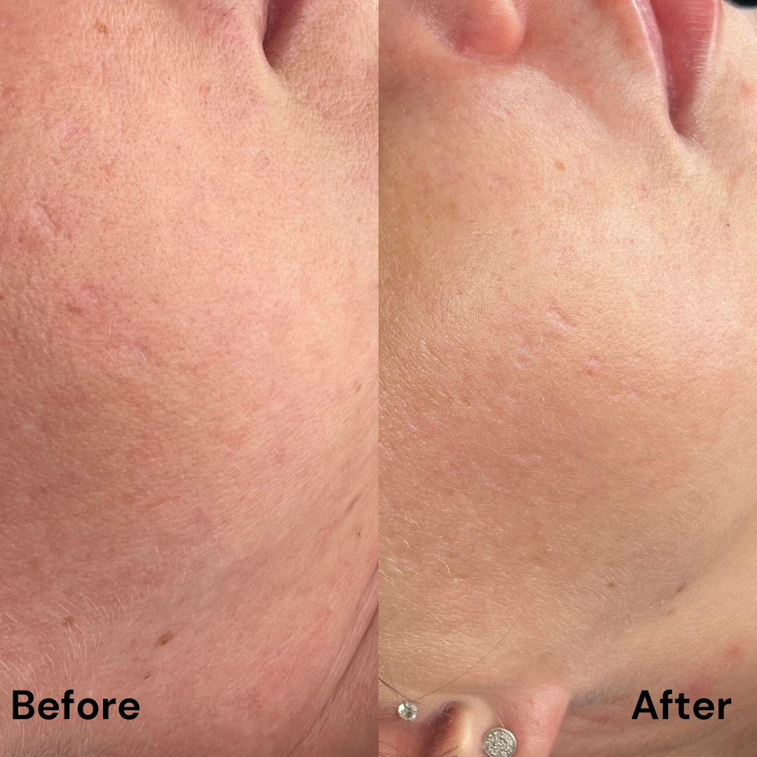 Protocol Dermapen VIP EXO
