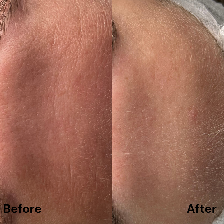 Protocol Dermapen VIP EXO