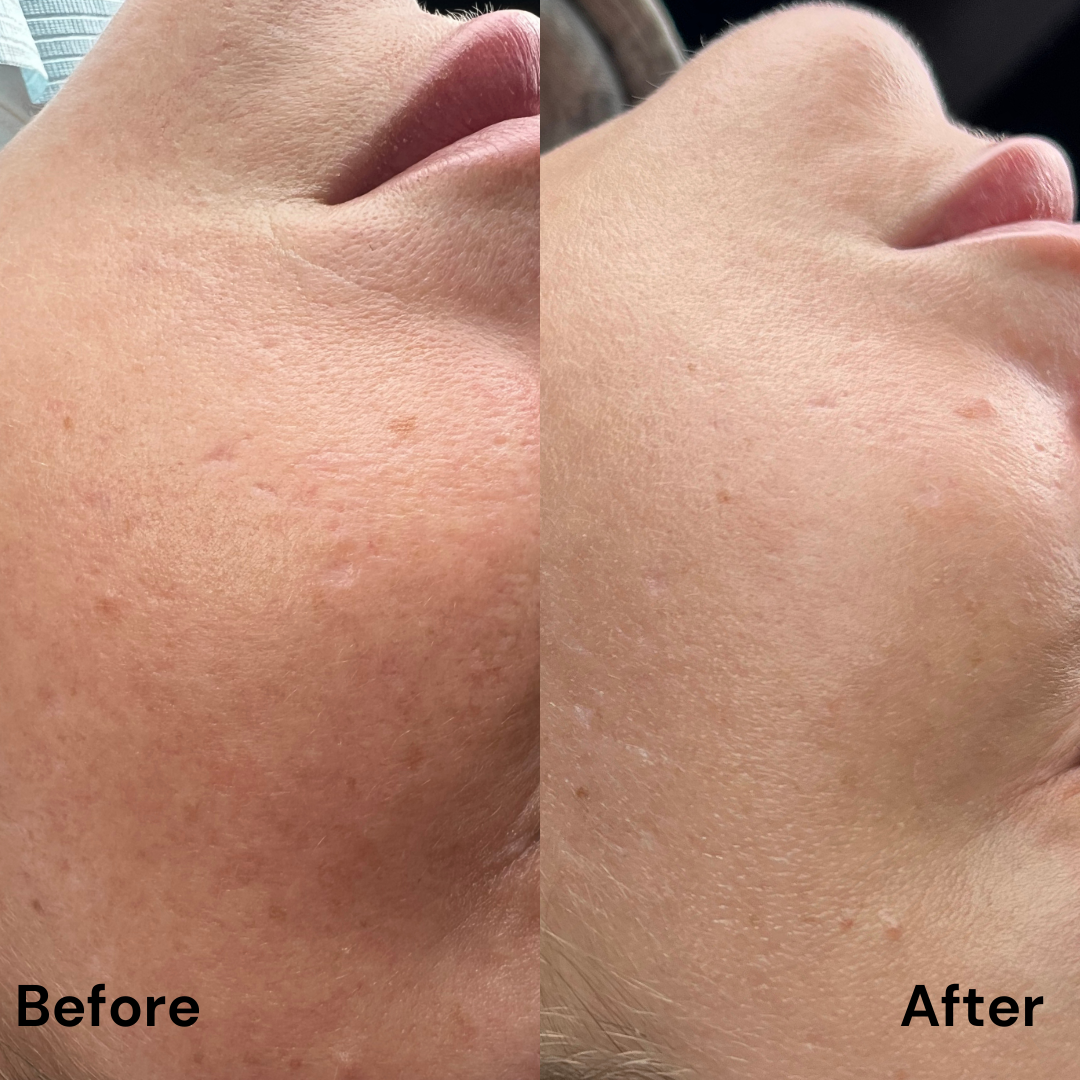 Protocol Dermapen VIP EXO