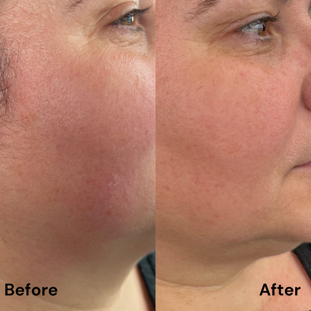 Tratarea imperfecțiunilor cu Dermapen 4 & MG Collection : pete hiperpigmentare/cuperoză/ riduri