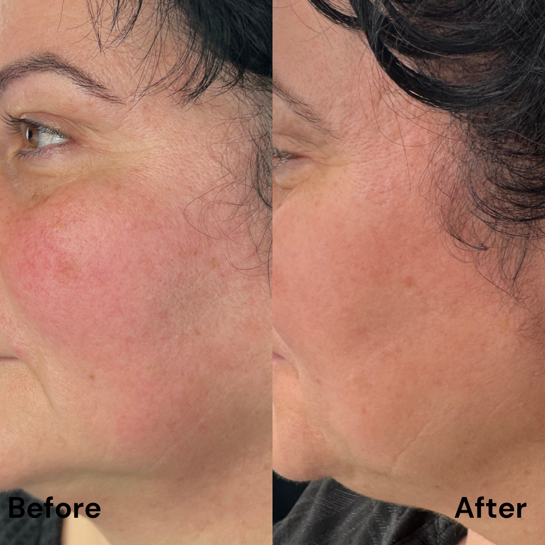 Tratarea imperfecțiunilor cu Dermapen 4 & MG Collection : pete hiperpigmentare/cuperoză/ riduri