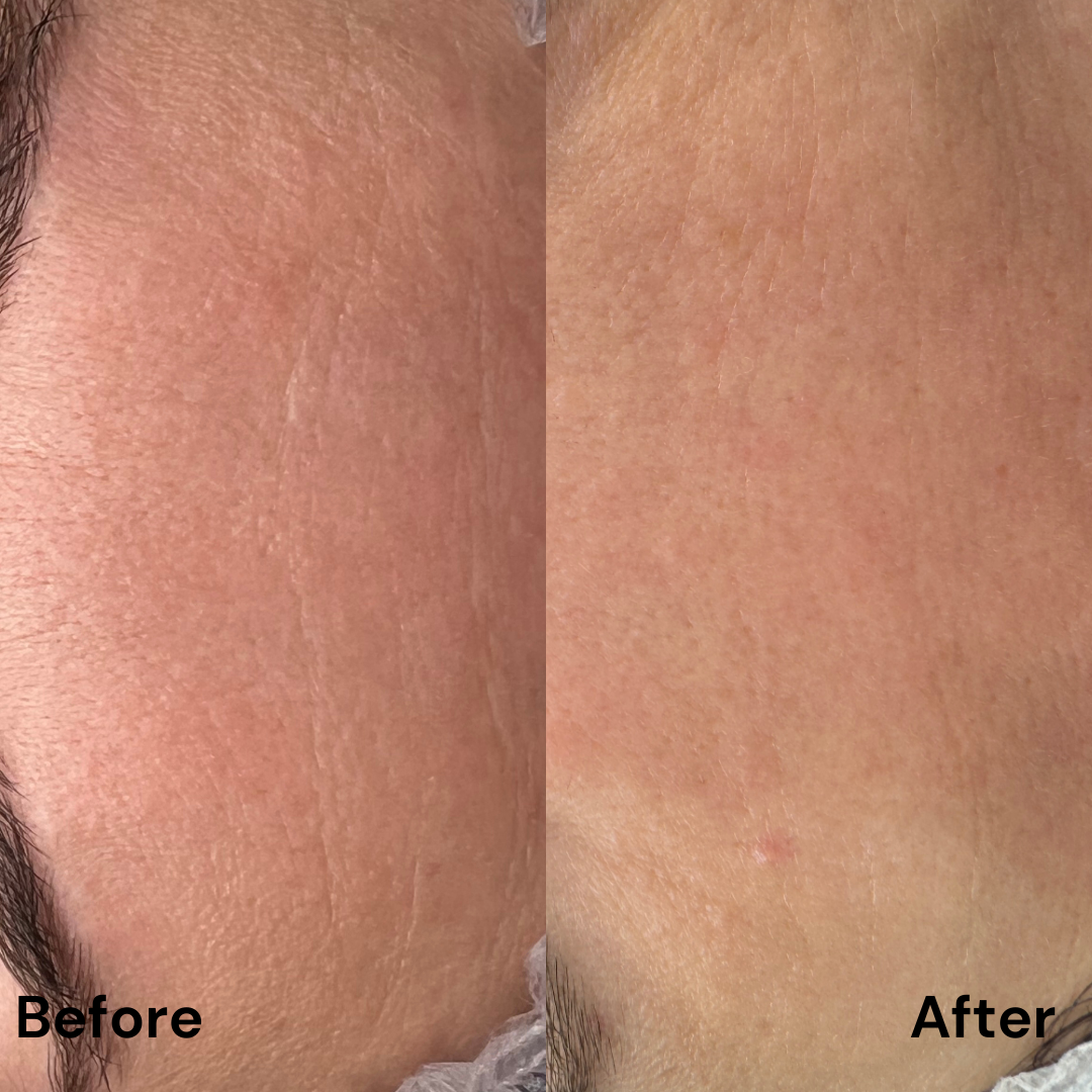 Tratarea imperfecțiunilor cu Dermapen 4 & MG Collection : pete hiperpigmentare/cuperoză/ riduri