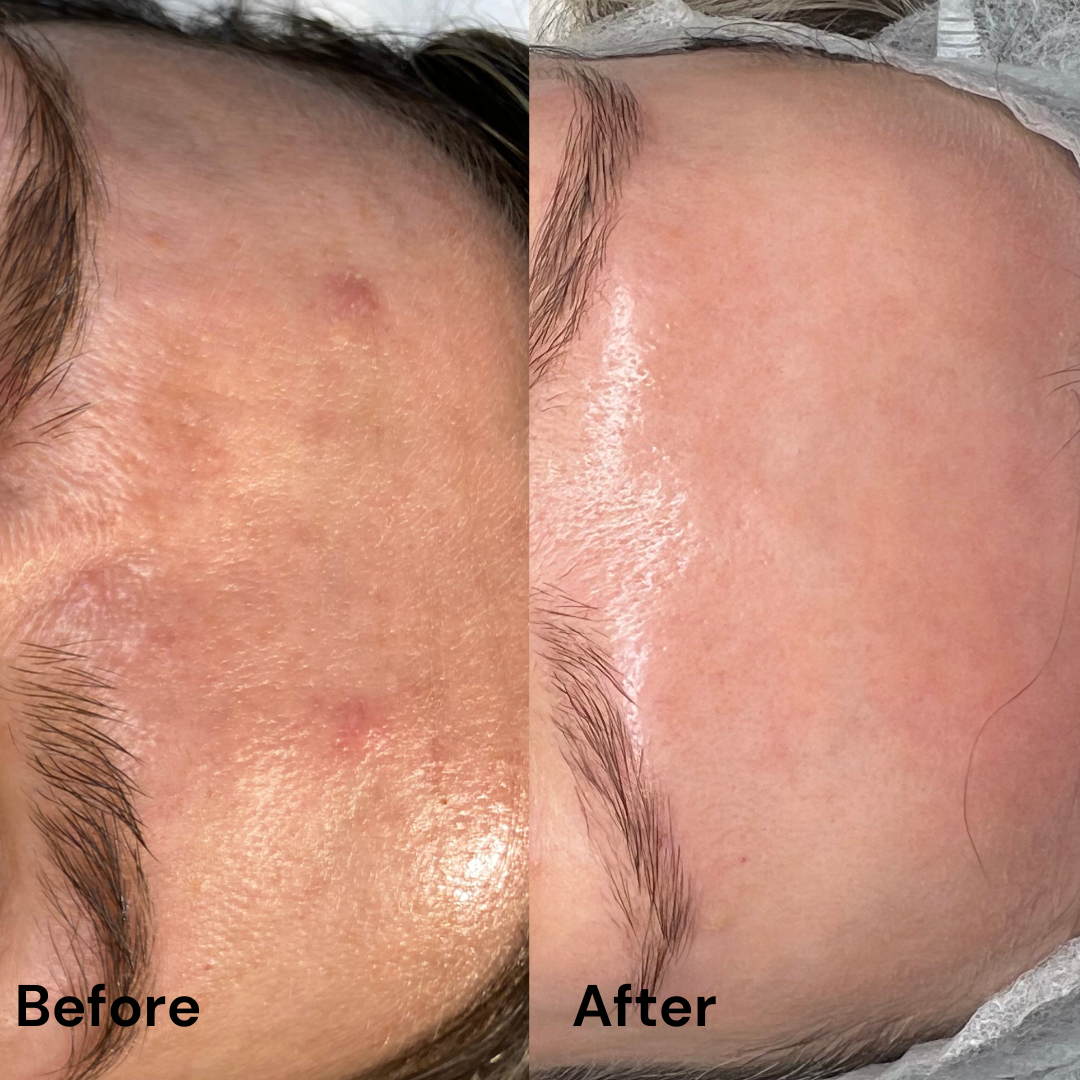 Protocol Dermapen VIP EXO
