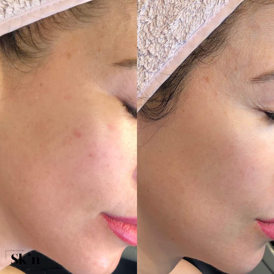 Protocol Dermapen VIP EXO