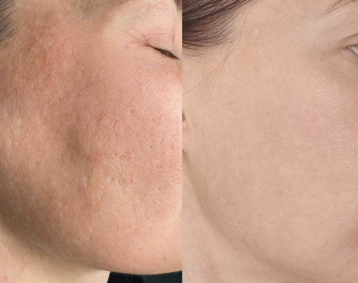 Protocol Dermapen VIP EXO