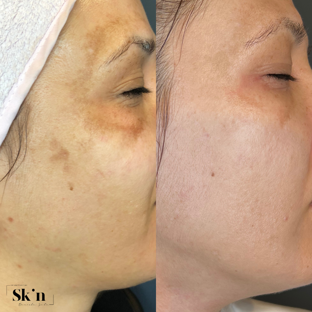 Tratarea imperfecțiunilor cu Dermapen 4 & MG Collection : pete hiperpigmentare/cuperoză/ riduri