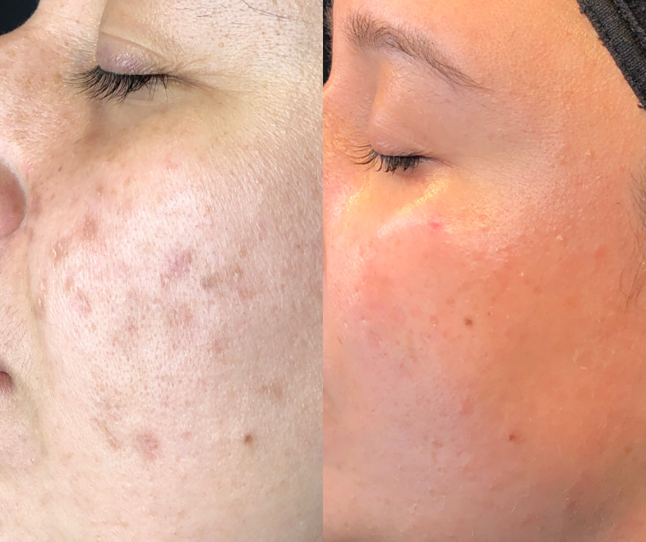 Tratarea imperfecțiunilor cu Dermapen 4 & MG Collection : pete hiperpigmentare/cuperoză/ riduri