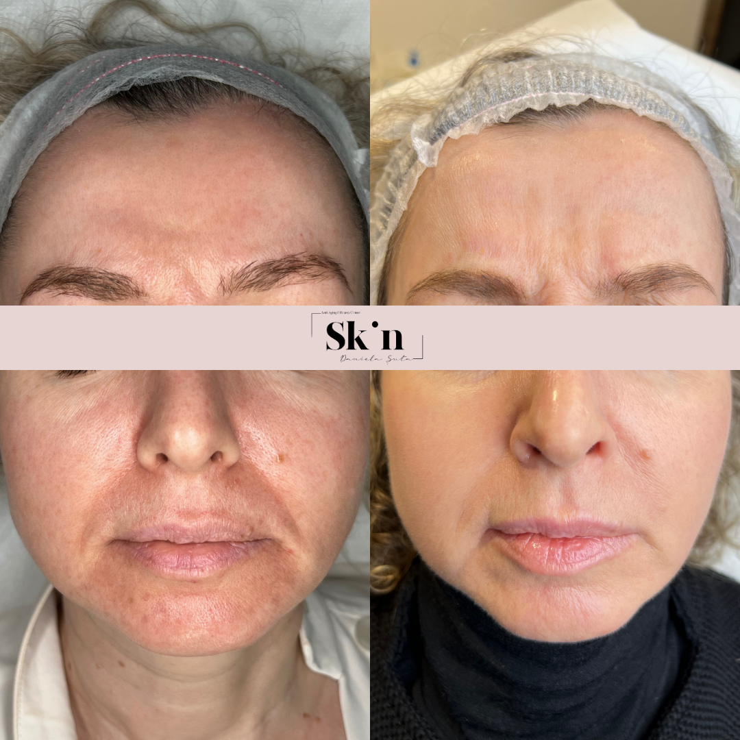 Protocol Dermapen VIP EXO
