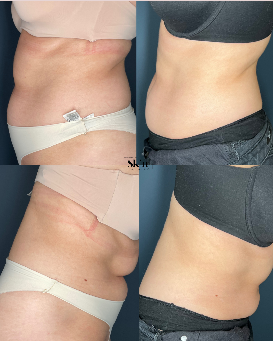 Remodelare și Fermitate Acceleratǎ cu NuEra® Tight & Lipolizǎ sau Fillere de biorevitalizare Sculptra
