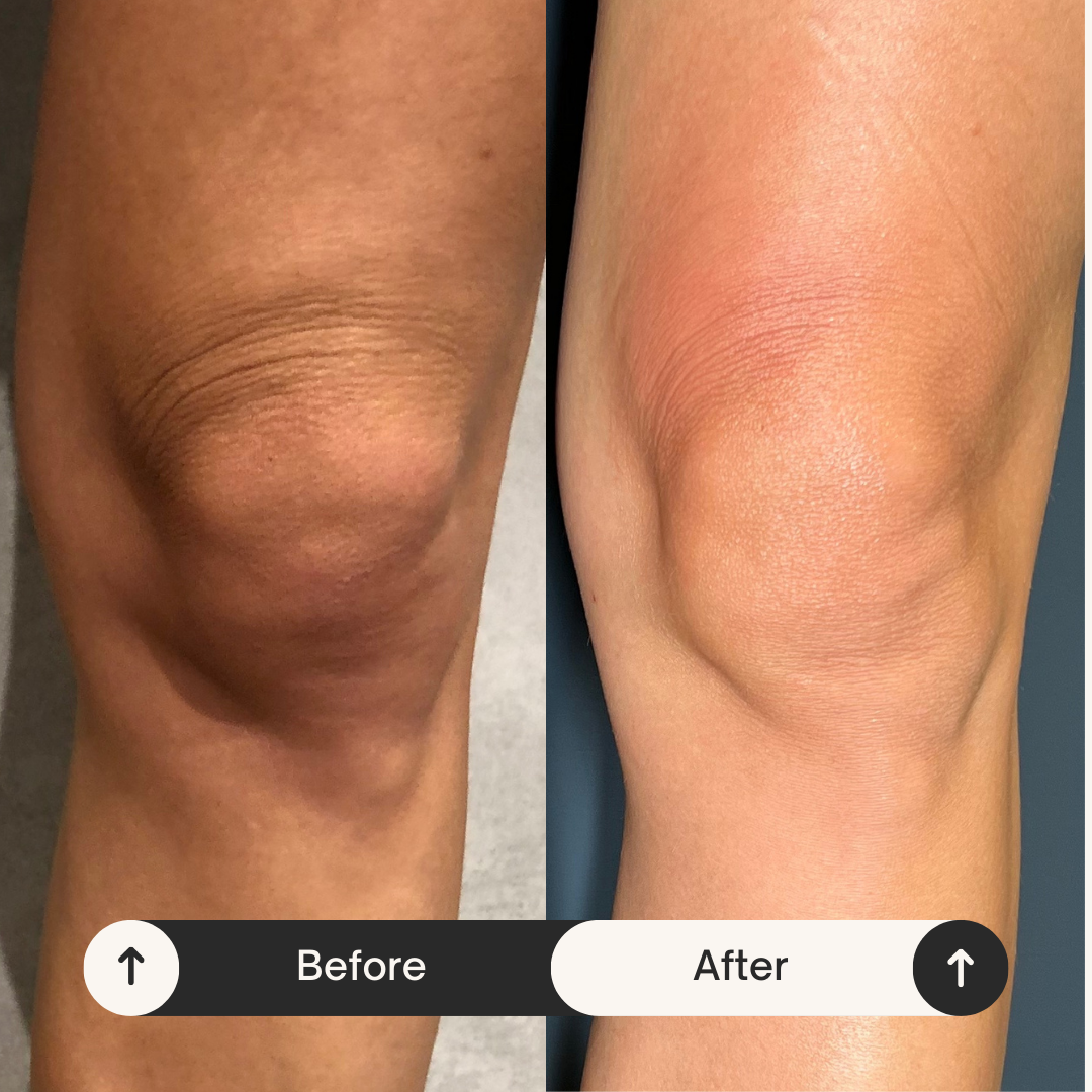 Remodelare și Fermitate Acceleratǎ cu NuEra® Tight & Lipolizǎ sau Fillere de biorevitalizare Sculptra