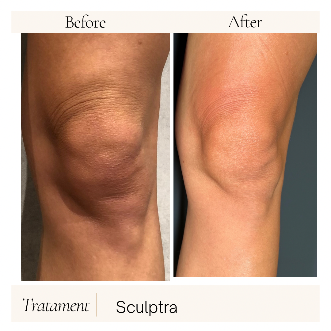 Remodelare și Fermitate Acceleratǎ cu NuEra® Tight & Lipolizǎ sau Fillere de biorevitalizare Sculptra