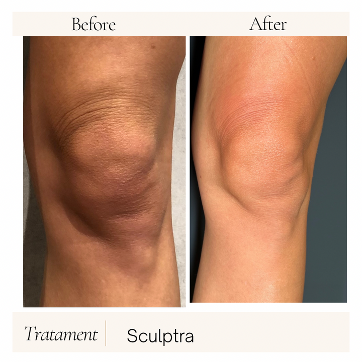 Remodelare și Fermitate Acceleratǎ cu NuEra® Tight & Lipolizǎ sau Fillere de biorevitalizare Sculptra