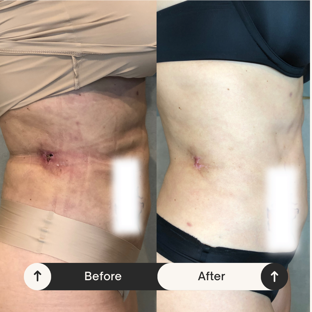 Remodelare și Fermitate Acceleratǎ cu NuEra® Tight & Lipolizǎ sau Fillere de biorevitalizare Sculptra