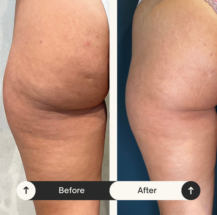 Remodelare și Fermitate Acceleratǎ cu NuEra® Tight & Lipolizǎ sau Fillere de biorevitalizare Sculptra