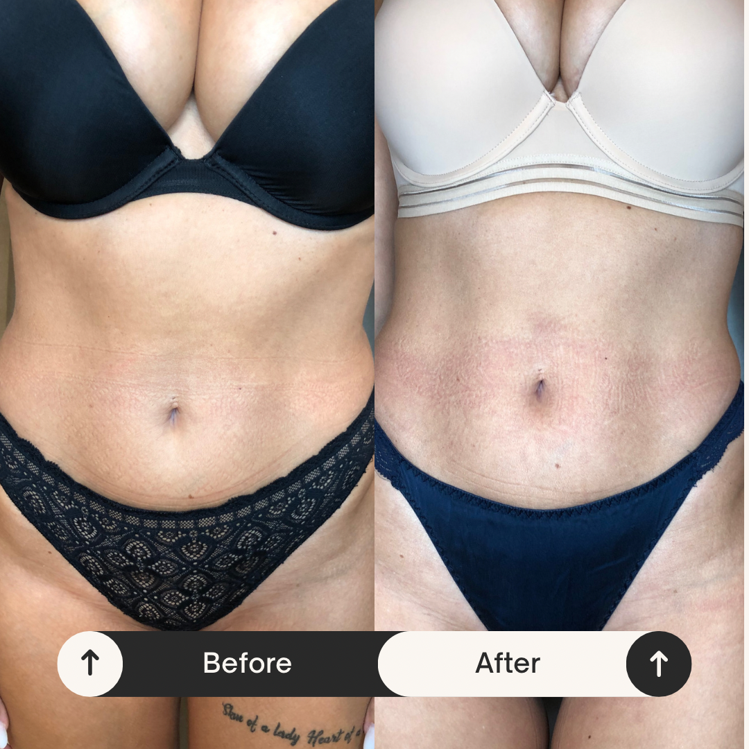 Remodelare și Fermitate Acceleratǎ cu NuEra® Tight & Lipolizǎ sau Fillere de biorevitalizare Sculptra