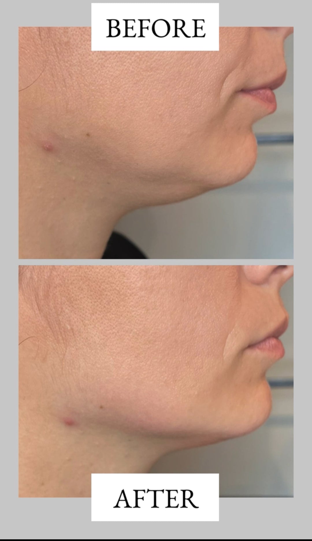Remodelare și Fermitate Acceleratǎ cu NuEra® Tight & Lipolizǎ sau Fillere de biorevitalizare Sculptra