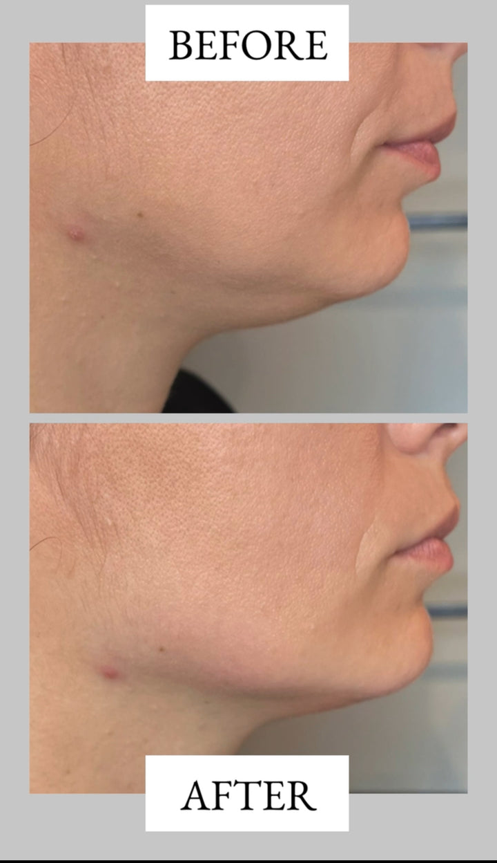 Remodelare și Fermitate Acceleratǎ cu NuEra® Tight & Lipolizǎ sau Fillere de biorevitalizare Sculptra