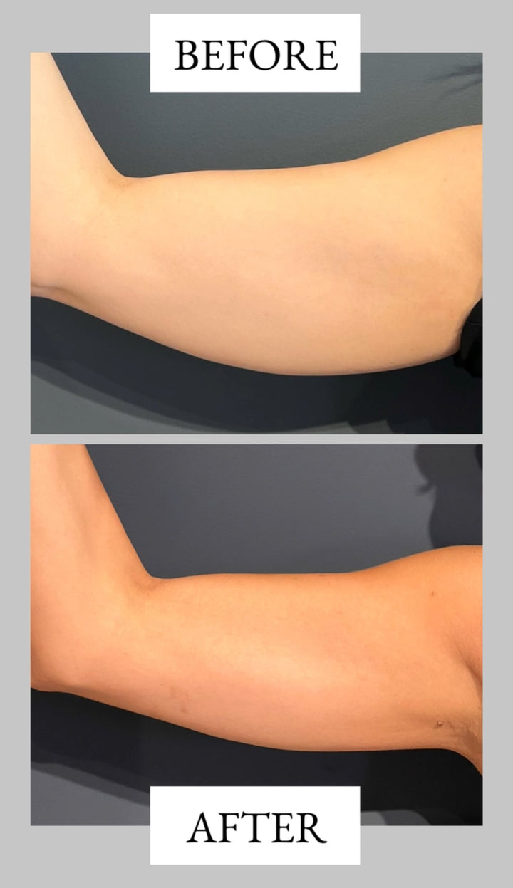 Remodelare și Fermitate Acceleratǎ cu NuEra® Tight & Lipolizǎ sau Fillere de biorevitalizare Sculptra