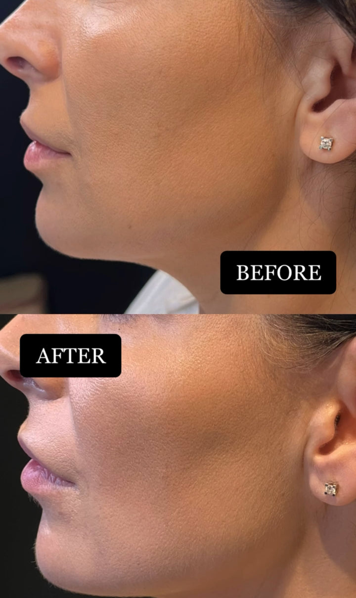 Remodelare și Fermitate Acceleratǎ cu NuEra® Tight & Lipolizǎ sau Fillere de biorevitalizare Sculptra