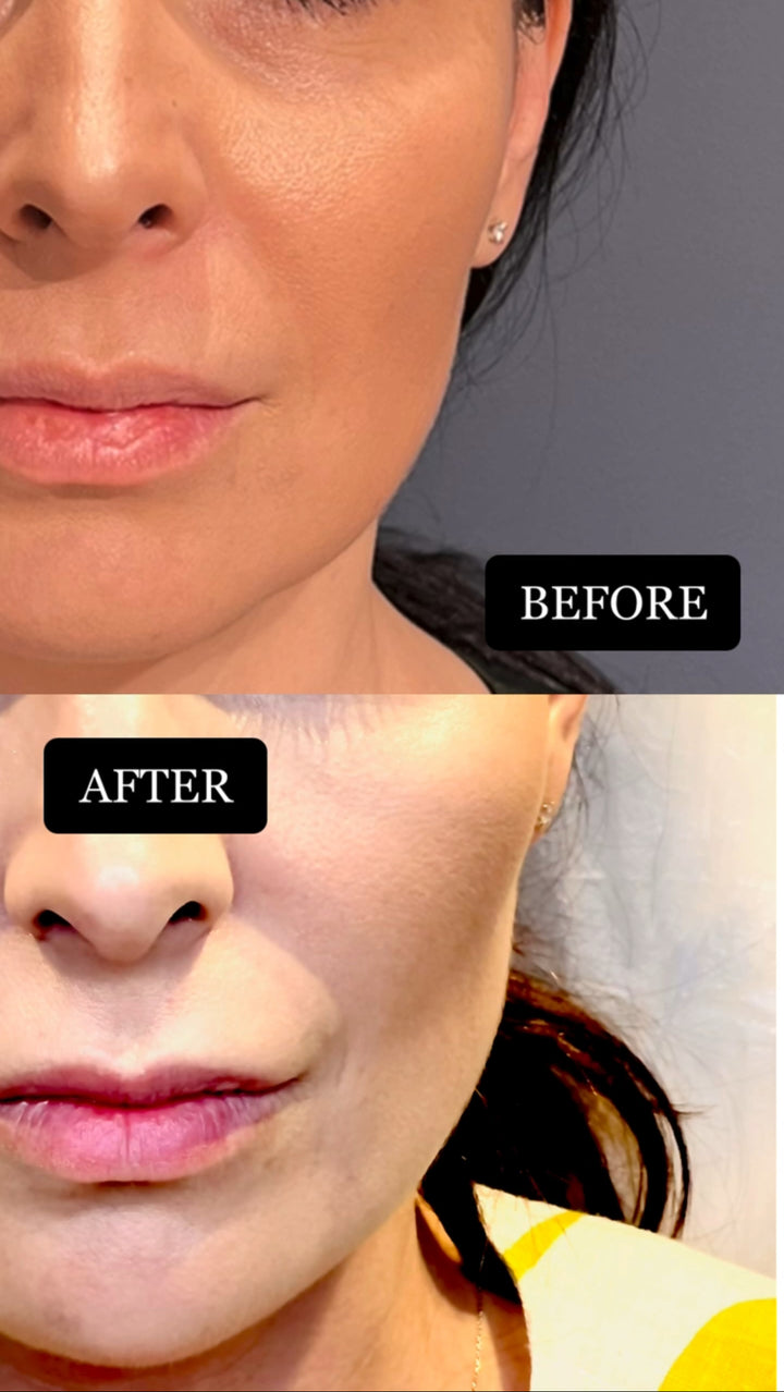 Remodelare și Fermitate Acceleratǎ cu NuEra® Tight & Lipolizǎ sau Fillere de biorevitalizare Sculptra