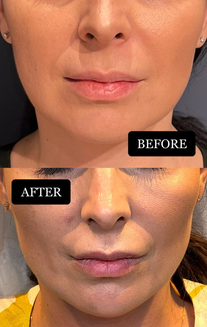 Remodelare și Fermitate Acceleratǎ cu NuEra® Tight & Lipolizǎ sau Fillere de biorevitalizare Sculptra
