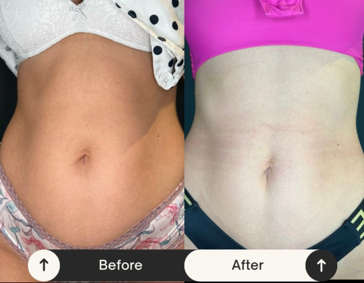 Remodelare și Fermitate Acceleratǎ cu NuEra® Tight & Lipolizǎ sau Fillere de biorevitalizare Sculptra