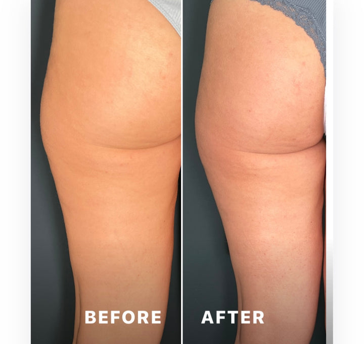 Remodelare și Fermitate Acceleratǎ cu NuEra® Tight & Lipolizǎ sau Fillere de biorevitalizare Sculptra