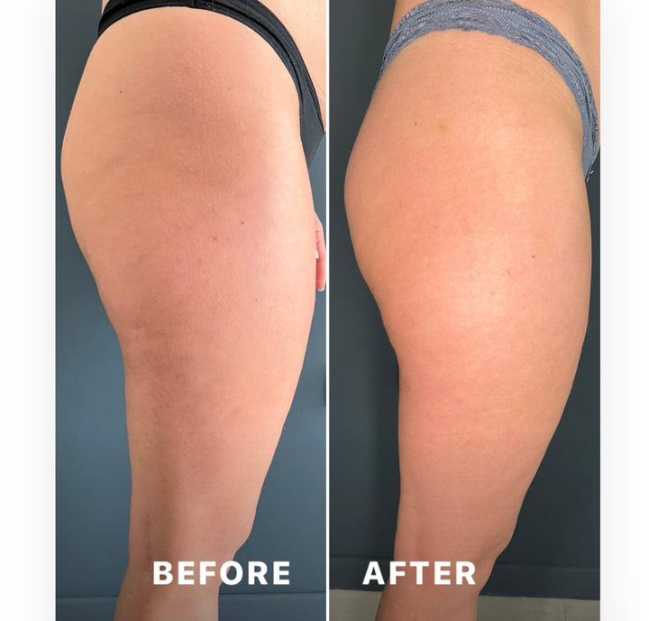 Remodelare și Fermitate Acceleratǎ cu NuEra® Tight & Lipolizǎ sau Fillere de biorevitalizare Sculptra