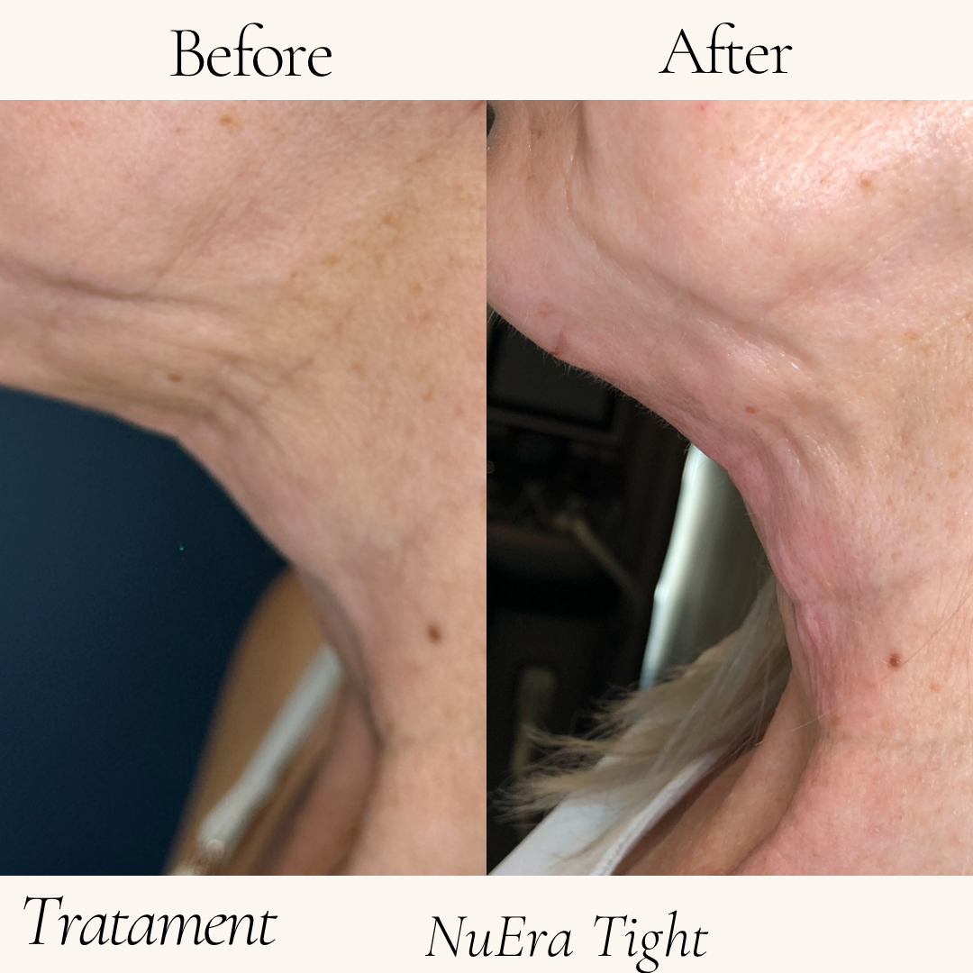 Remodelare și Fermitate Acceleratǎ cu NuEra® Tight & Lipolizǎ sau Fillere de biorevitalizare Sculptra